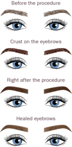 Eyebrow Healing Process