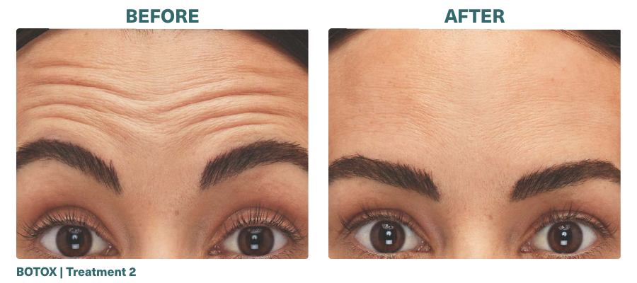 Before+After_BOTOX