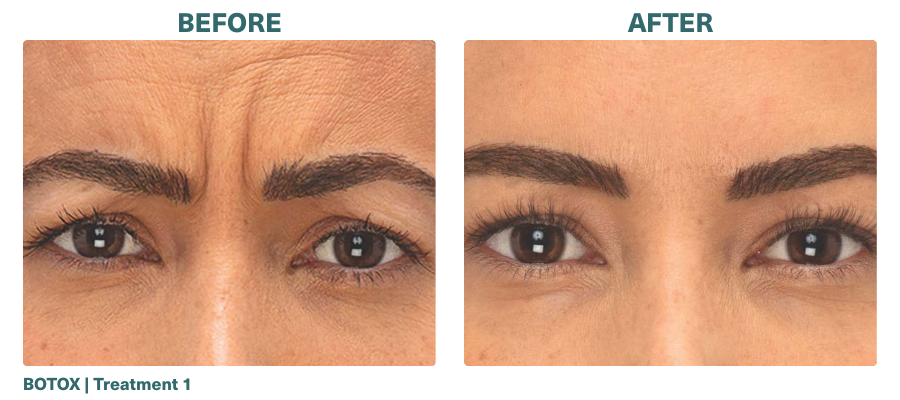 Before+After_BOTOX_2