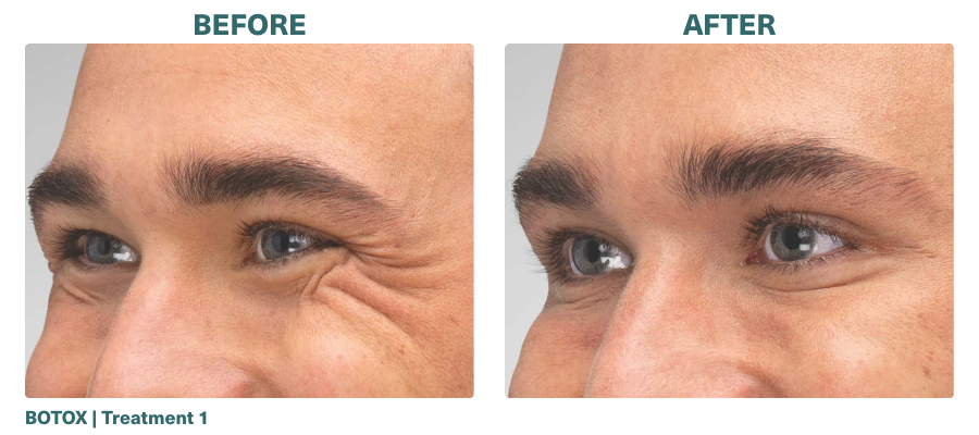 Before+After_BOTOX_3