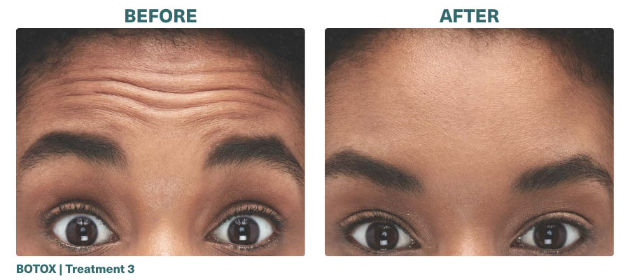 Before+After_BOTOX_4