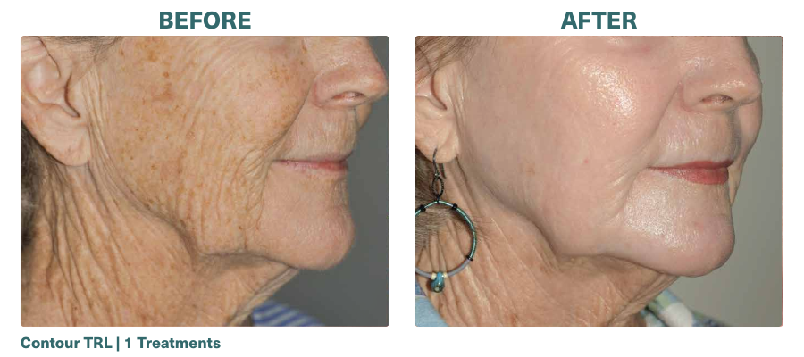 Before+After_Contour TRL