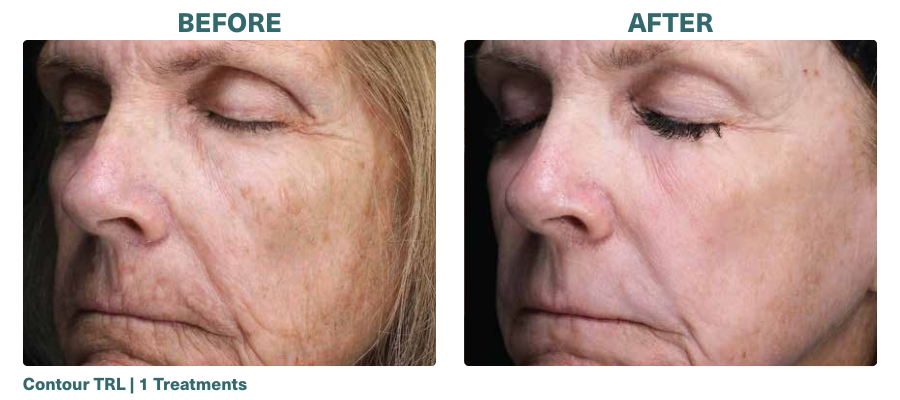 Before+After_Contour TRL_2