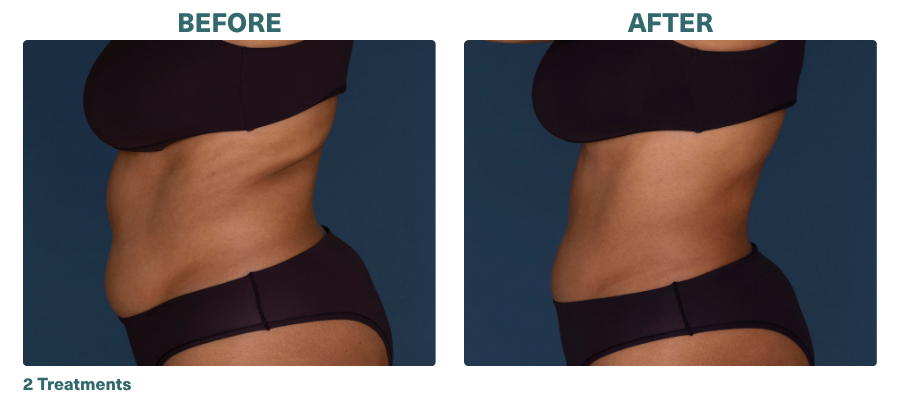 Before+After_CoolSculpting