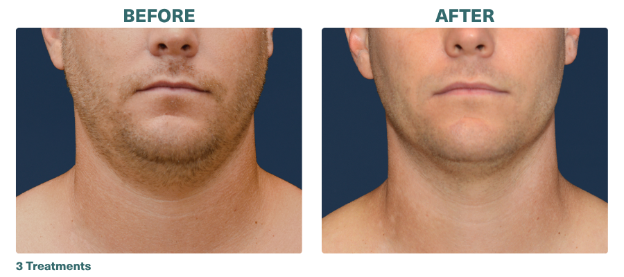 Before+After_CoolSculpting_2