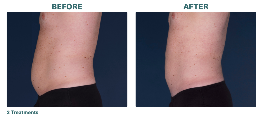 Before+After_CoolSculpting_3