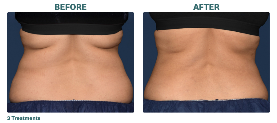 Before+After_CoolSculpting_4