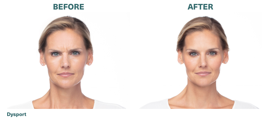 Before+After_Dysport
