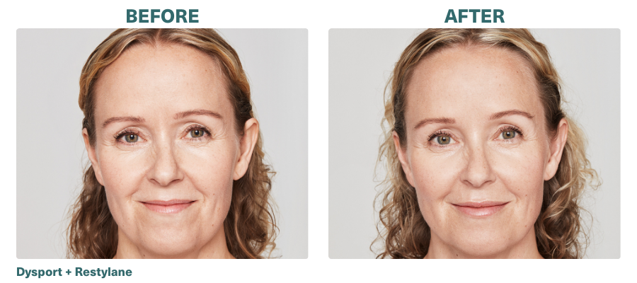 Before+After_Dysport+Restylane