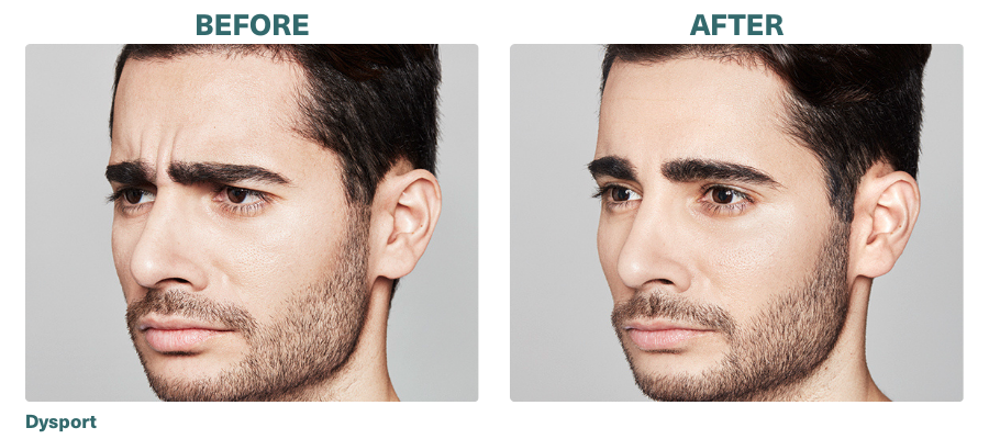 Before+After_Dysport_2