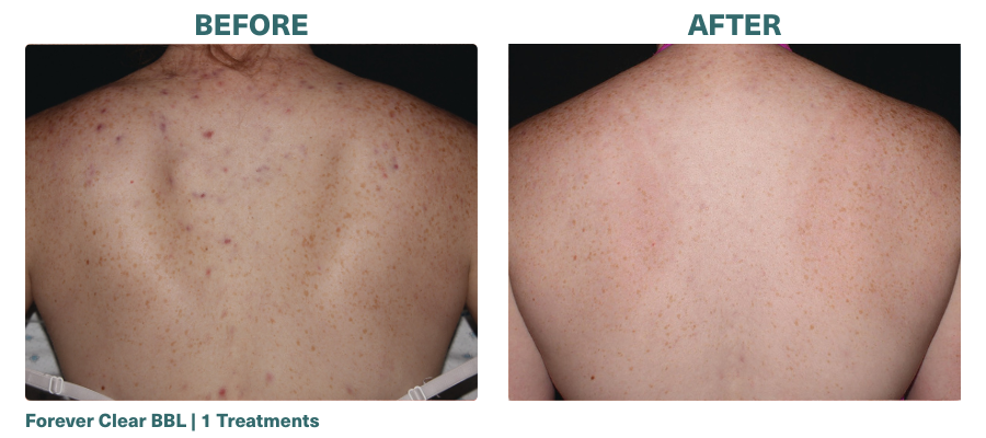 Before+After_Forever Clear BBL_2