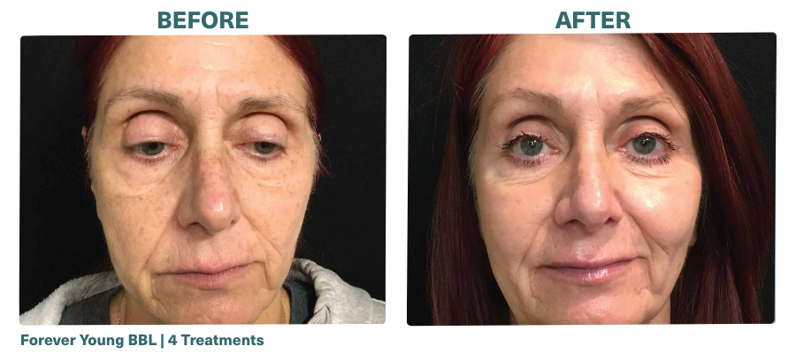 Before+After_Forver Young BBL