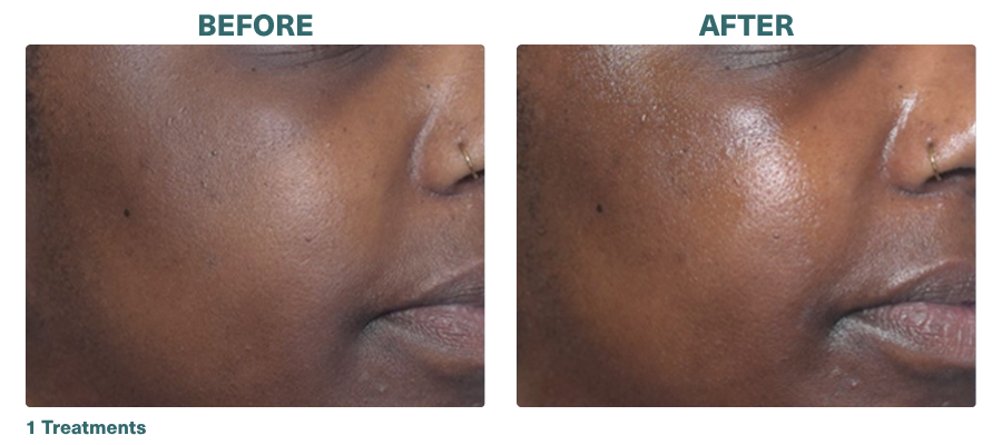 Before+After_HydraFacial