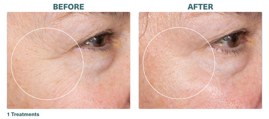 Before+After_HydraFacial_2