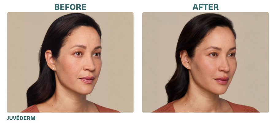 Before+After_JUVÉDERM
