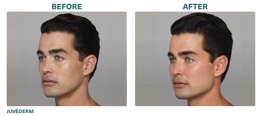 Before+After_JUVÉDERM_2