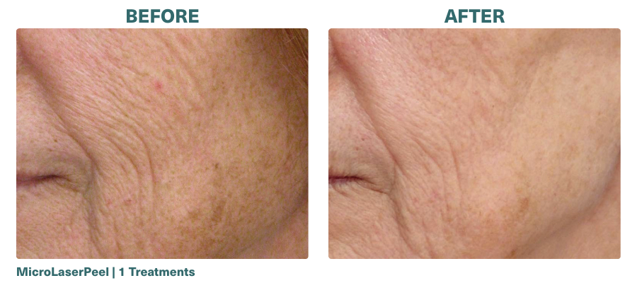 Before+After_MicroLaserPeel