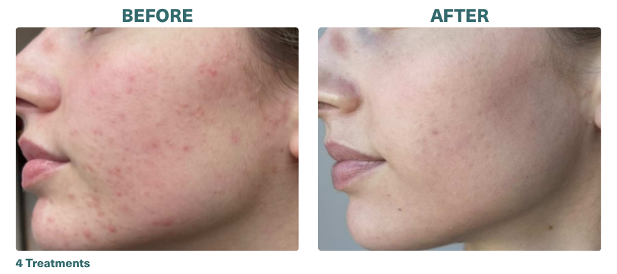 Before+After_Microneedling