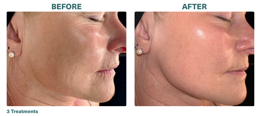 Before+After_Microneedling_2