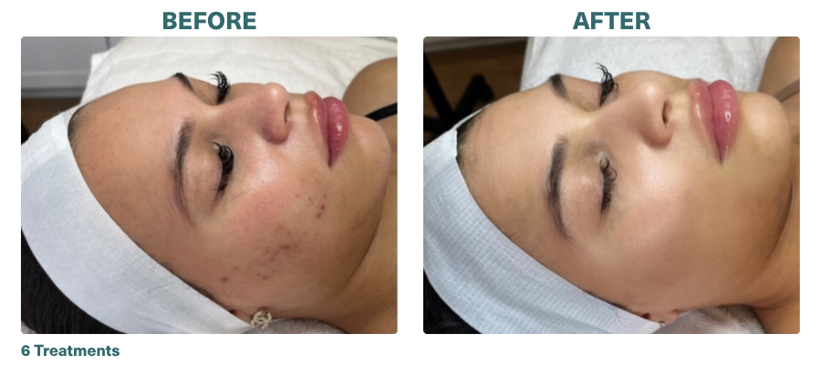 Before+After_Microneedling_3