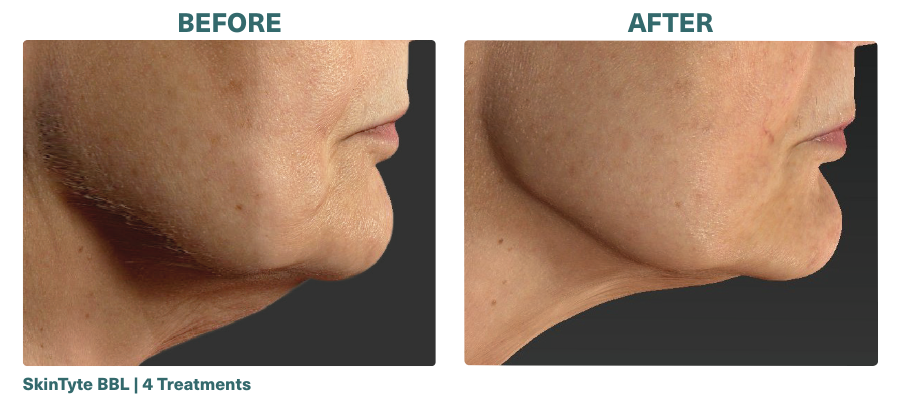 Before+After_SkinTyte BBL