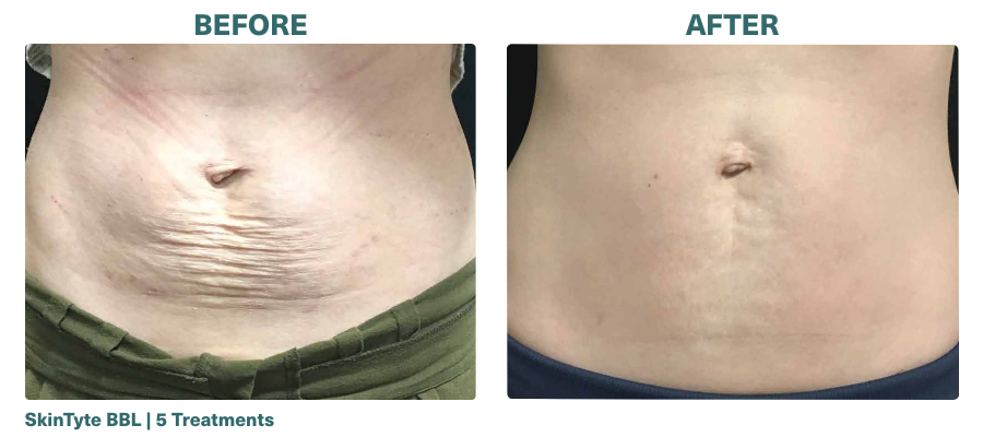 Before+After_SkinTyte BBL_2