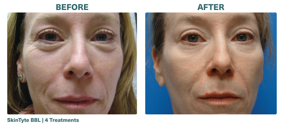 Before+After_SkinTyte BBL_3